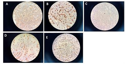 Combined treatment for a rare malignant glomus tumor of the esophagus with pulmonary and liver metastases: a case report and review of literature